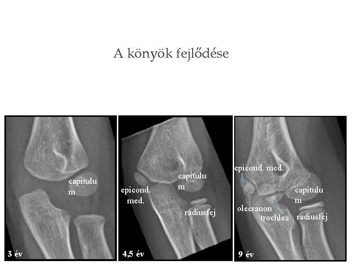 CRITOE A könyök fejlődése capitulu m epicond. med. capitulu m radiusfej 3 év 4,