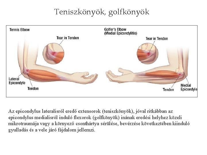 Teniszkönyök, golfkönyök Az epicondylus lateralisról eredő extensorok (teniszkönyök), jóval ritkábban az epicondylus medialisról induló