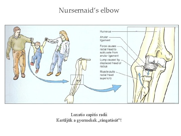 Nursemaid’s elbow Luxatio capitis radii Kerüljük a gyermekek „rángatását”! 