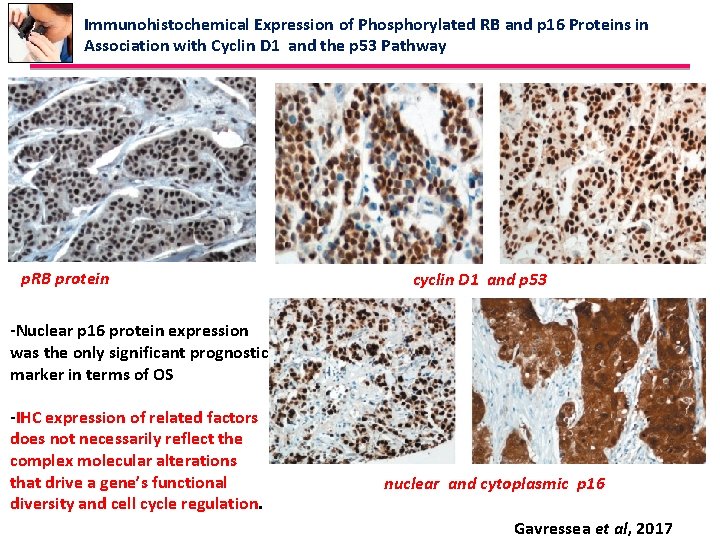 Immunohistochemical Expression of Phosphorylated RB and p 16 Proteins in Association with Cyclin D