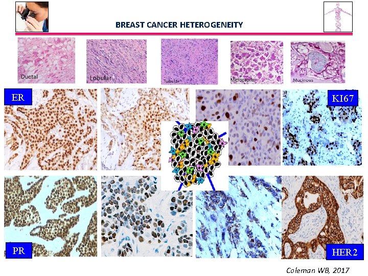 BREAST CANCER HETEROGENEITY ER KI 67 PR HER 2 Coleman WB, 2017 