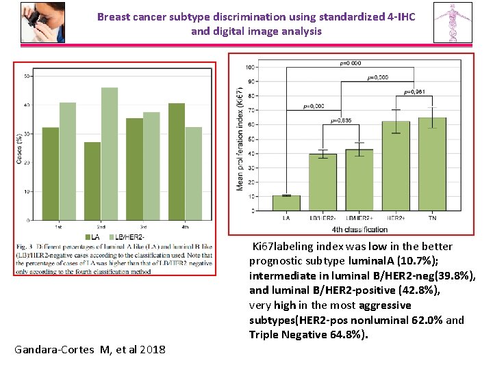 Breast cancer subtype discrimination using standardized 4 -IHC and digital image analysis Gandara-Cortes M,