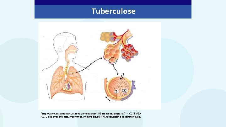 Tuberculose “http: //www. portaleducativo. net/quinto-basico/14/Sistema-respiratorio” – CC BY/SA 4. 0. Disponível em: https: //commons.