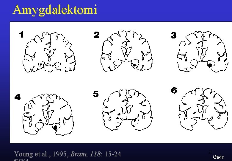 Amygdalektomi Young et al. , 1995, Brain, 118: 15 -24 23 Gade 