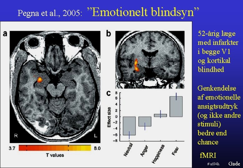 Pegna et al. , 2005: ”Emotionelt blindsyn” 52 -årig læge med infarkter i begge