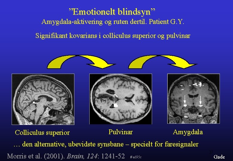 ”Emotionelt blindsyn” Amygdala-aktivering og ruten dertil. Patient G. Y. Signifikant kovarians i colliculus superior