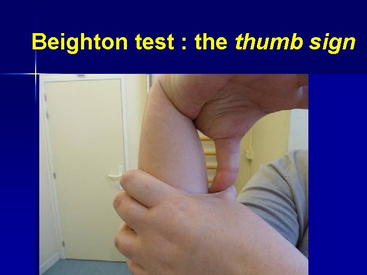 Beighton test : the thumb sign 