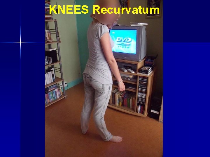 KNEES Recurvatum 