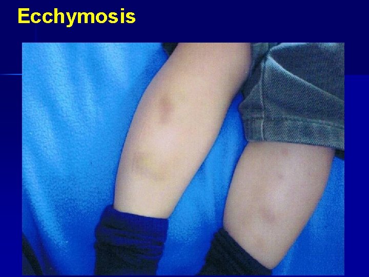 Ecchymosis 