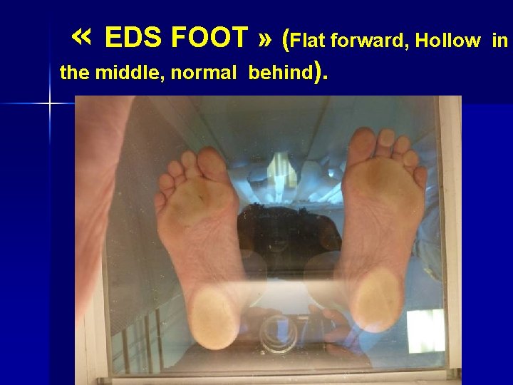  « EDS FOOT » (Flat forward, Hollow in the middle, normal behind). 