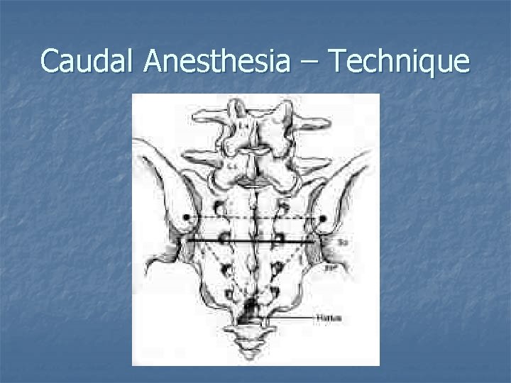 Caudal Anesthesia – Technique 