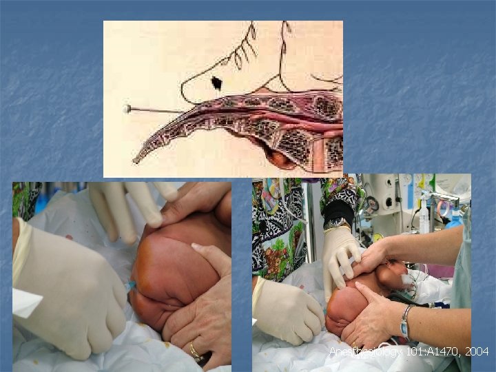 Anesthesiology 101: A 1470, 2004 