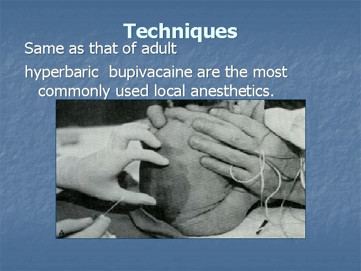 Techniques Same as that of adult hyperbaric bupivacaine are the most commonly used local