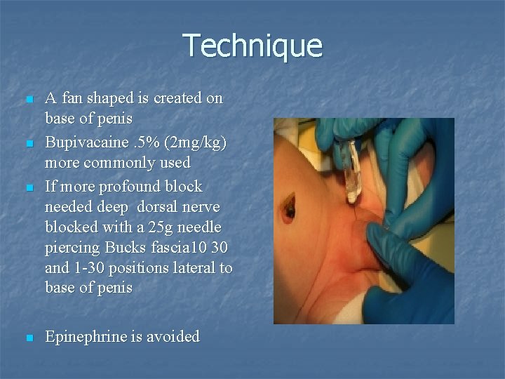 Technique n A fan shaped is created on base of penis Bupivacaine. 5% (2