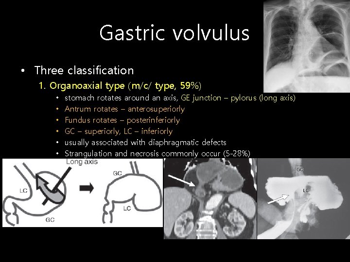 Gastric volvulus • Three classification 1. Organoaxial type (m/c/ type, 59%) • • •