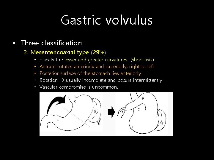 Gastric volvulus • Three classification 2. Mesentericoaxial type (29%) • • • bisects the