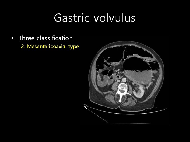 Gastric volvulus • Three classification 2. Mesentericoaxial type (29%) 