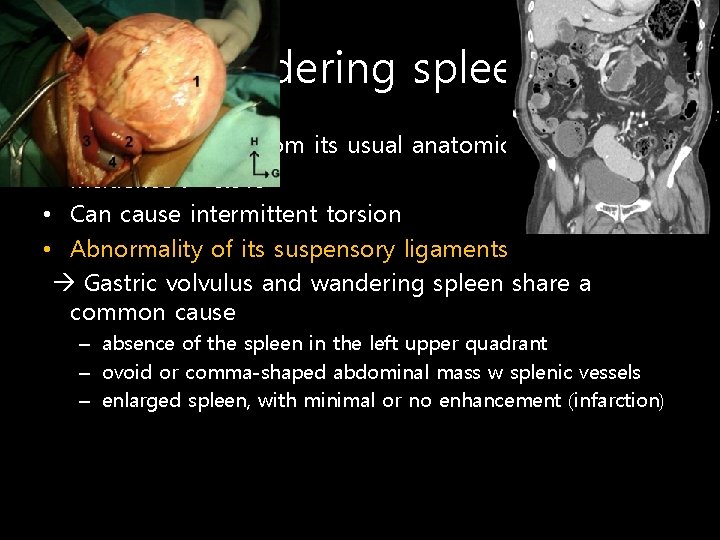 Wandering spleen • Spleen migrates from its usual anatomical position • Incidence : <0.