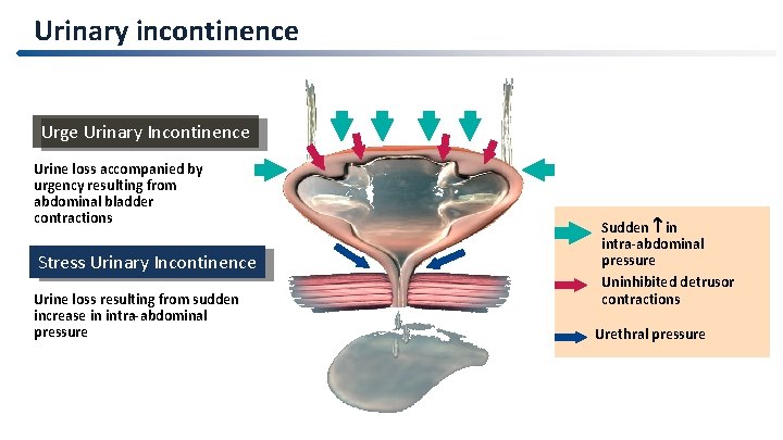Urinary incontinence Urge Urinary Incontinence Urine loss accompanied by urgency resulting from abdominal bladder