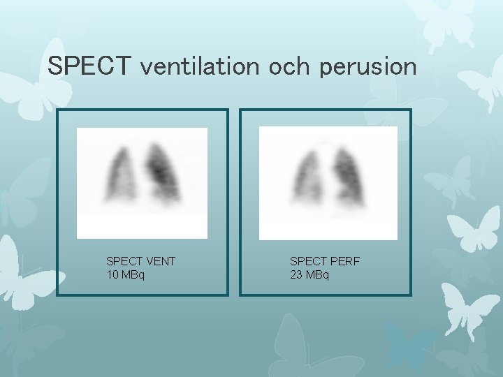 SPECT ventilation och perusion SPECT VENT 10 MBq SPECT PERF 23 MBq 