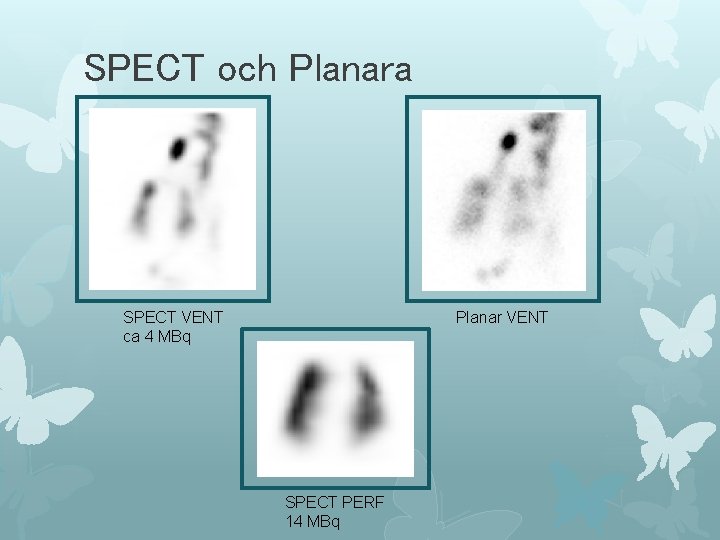 SPECT och Planara SPECT VENT ca 4 MBq Planar VENT SPECT PERF 14 MBq