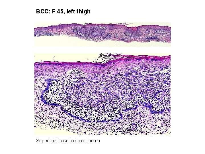 BCC: F 45, left thigh Superficial basal cell carcinoma 