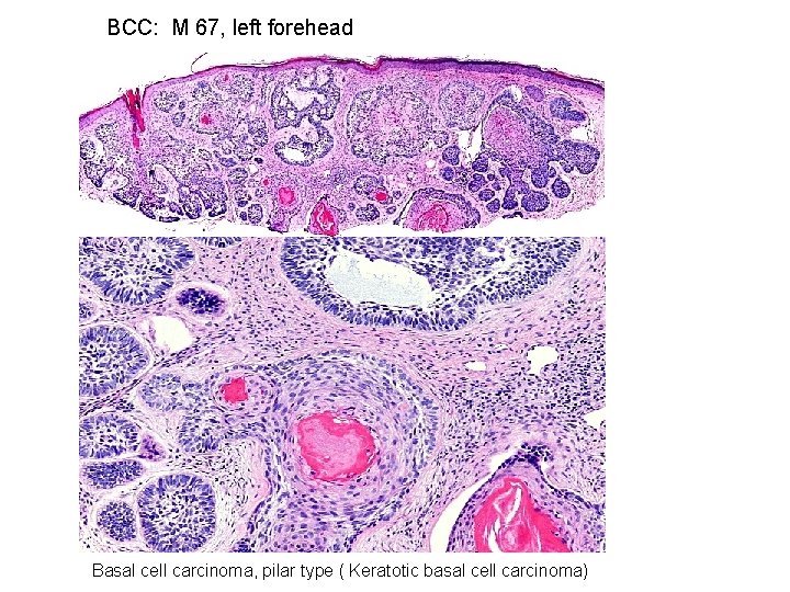 BCC: M 67, left forehead Basal cell carcinoma, pilar type ( Keratotic basal cell
