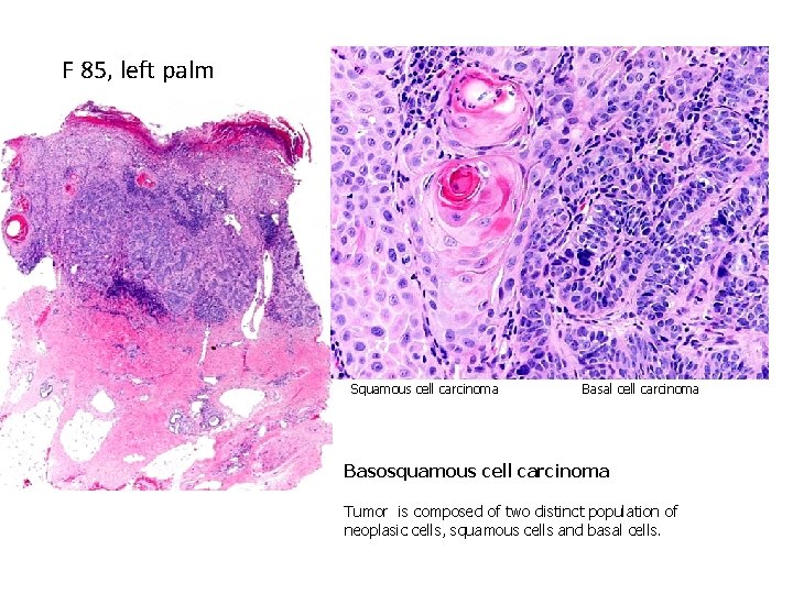 F 85, left palm Squamous cell carcinoma Basal cell carcinoma Basosquamous cell carcinoma Tumor