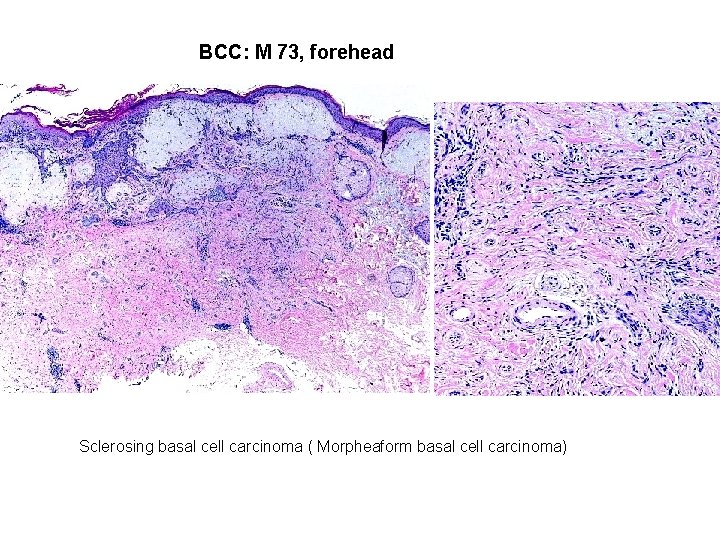 BCC: M 73, forehead Sclerosing basal cell carcinoma ( Morpheaform basal cell carcinoma) 