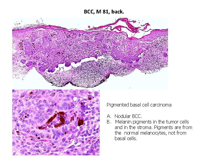 BCC, M 81, back. Pigmented basal cell carcinoma A. Nodular BCC. B. Melanin pigments