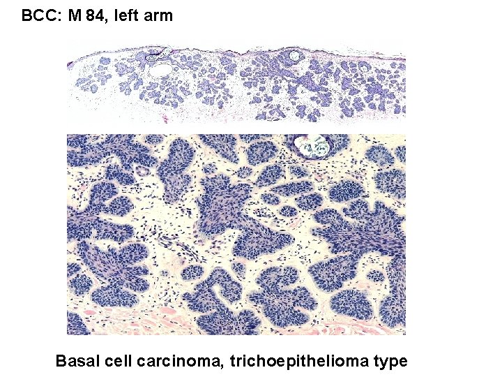 BCC: M 84, left arm Basal cell carcinoma, trichoepithelioma type 