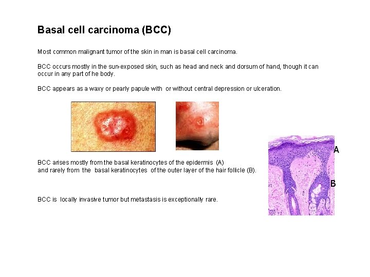 Basal cell carcinoma (BCC) Most common malignant tumor of the skin in man is