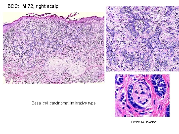 BCC: M 72, right scalp Basal cell carcinoma, infiltrative type Perineural invasion 
