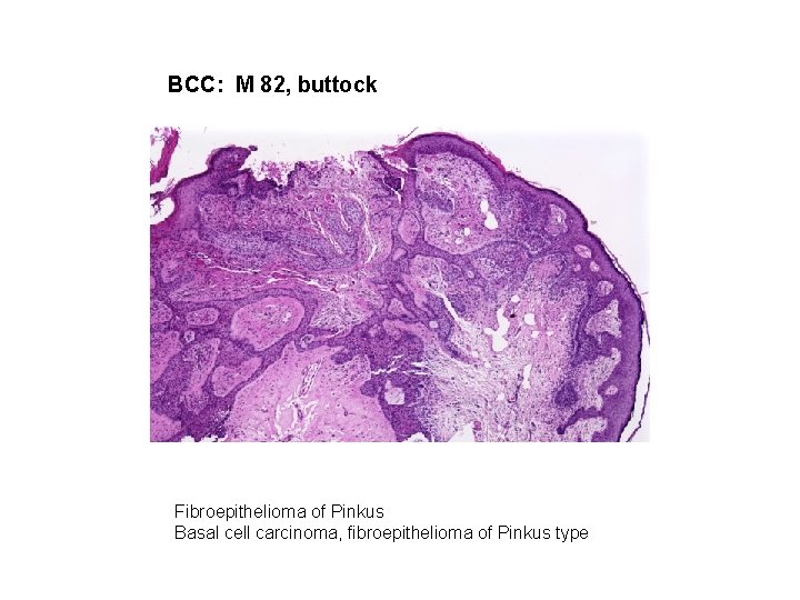 BCC: M 82, buttock Fibroepithelioma of Pinkus Basal cell carcinoma, fibroepithelioma of Pinkus type