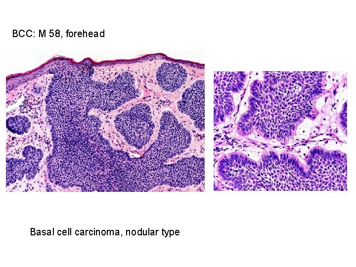 BCC: M 58, forehead Basal cell carcinoma, nodular type 