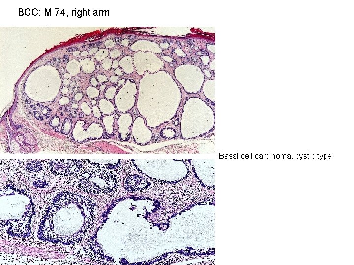 BCC: M 74, right arm Basal cell carcinoma, cystic type 