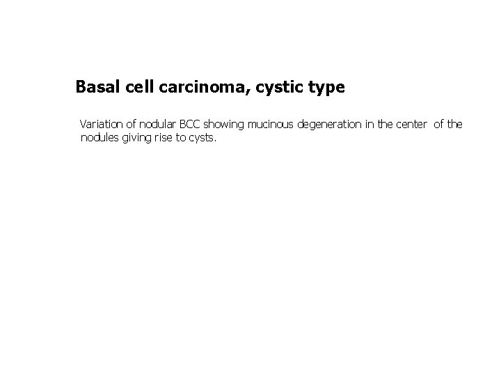 Basal cell carcinoma, cystic type Variation of nodular BCC showing mucinous degeneration in the