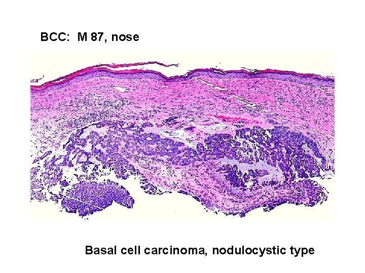 BCC: M 87, nose Basal cell carcinoma, nodulocystic type 