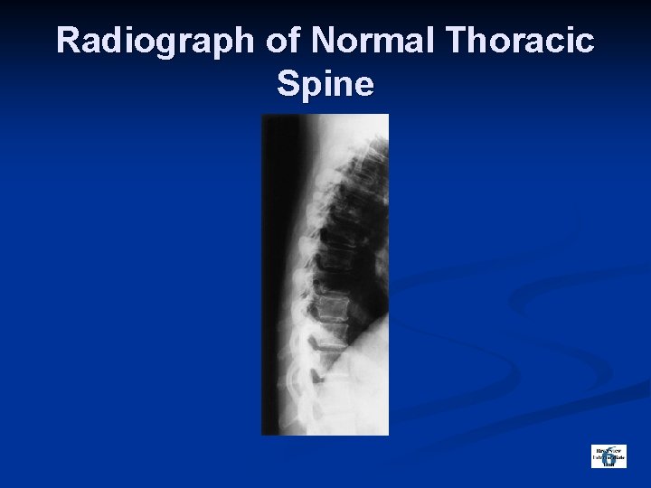 Radiograph of Normal Thoracic Spine 