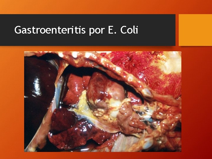 Gastroenteritis por E. Coli 