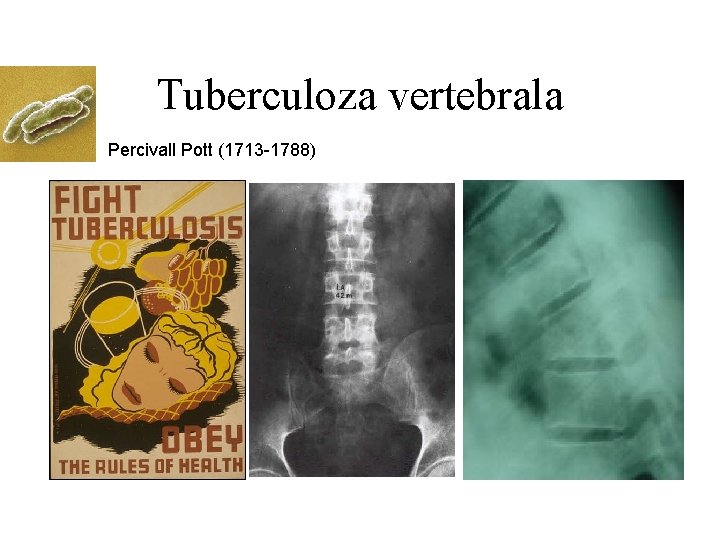 Tuberculoza vertebrala Percivall Pott (1713 -1788) 