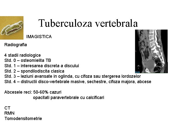 Tuberculoza vertebrala IMAGISTICA Radiografia 4 stadii radiologice Std. 0 – osteomielita TB Std. 1