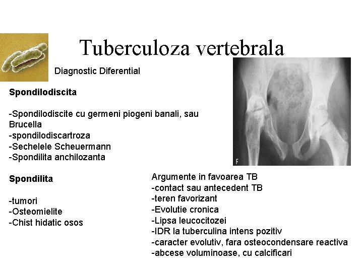 Tuberculoza vertebrala Diagnostic Diferential Spondilodiscita -Spondilodiscite cu germeni piogeni banali, sau Brucella -spondilodiscartroza -Sechelele