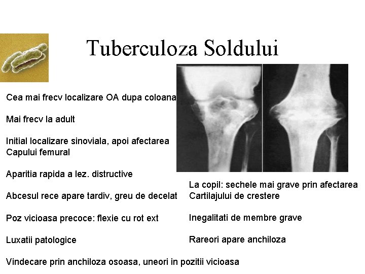 Tuberculoza Soldului Cea mai frecv localizare OA dupa coloana Mai frecv la adult Initial