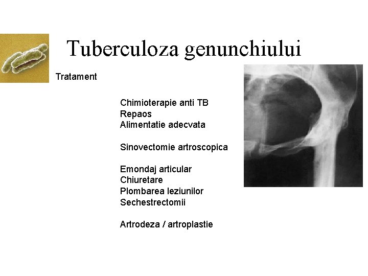 Tuberculoza genunchiului Tratament Chimioterapie anti TB Repaos Alimentatie adecvata Sinovectomie artroscopica Emondaj articular Chiuretare
