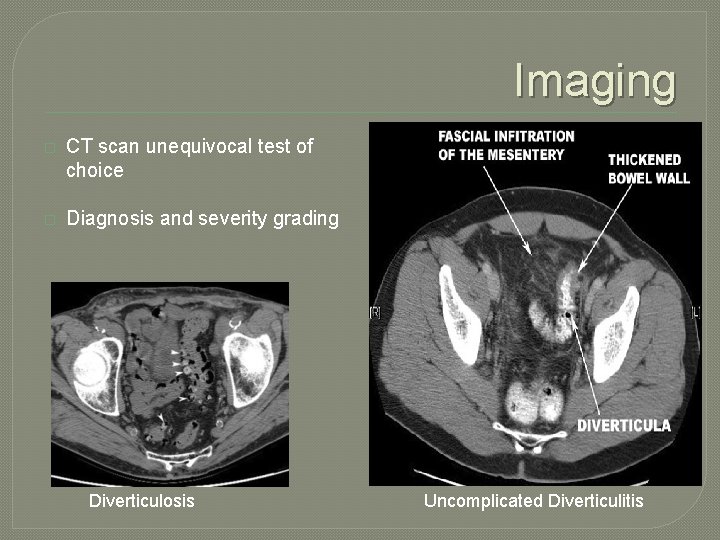 Imaging � CT scan unequivocal test of choice � Diagnosis and severity grading Diverticulosis