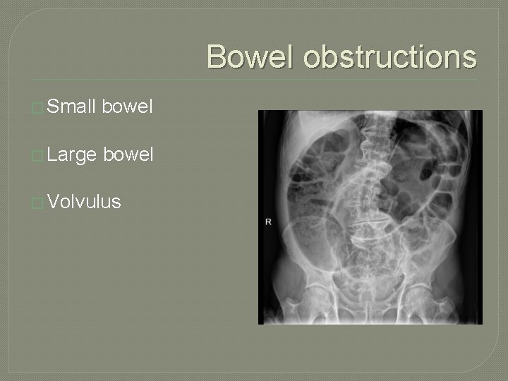Bowel obstructions � Small bowel � Large bowel � Volvulus 