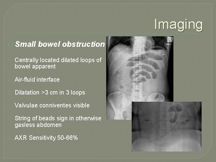 Imaging � Small bowel obstruction � Centrally located dilated loops of bowel apparent �