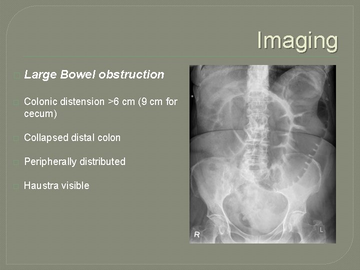 Imaging � Large Bowel obstruction � Colonic distension >6 cm (9 cm for cecum)