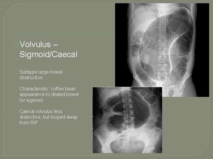 Imaging � Volvulus – Sigmoid/Caecal � Subtype large bowel obstruction. � Characteristic ‘coffee bean’